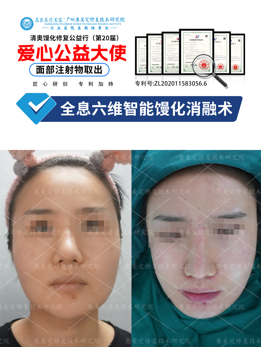 奥美定面部填充致肿胀增生，来院成功取出