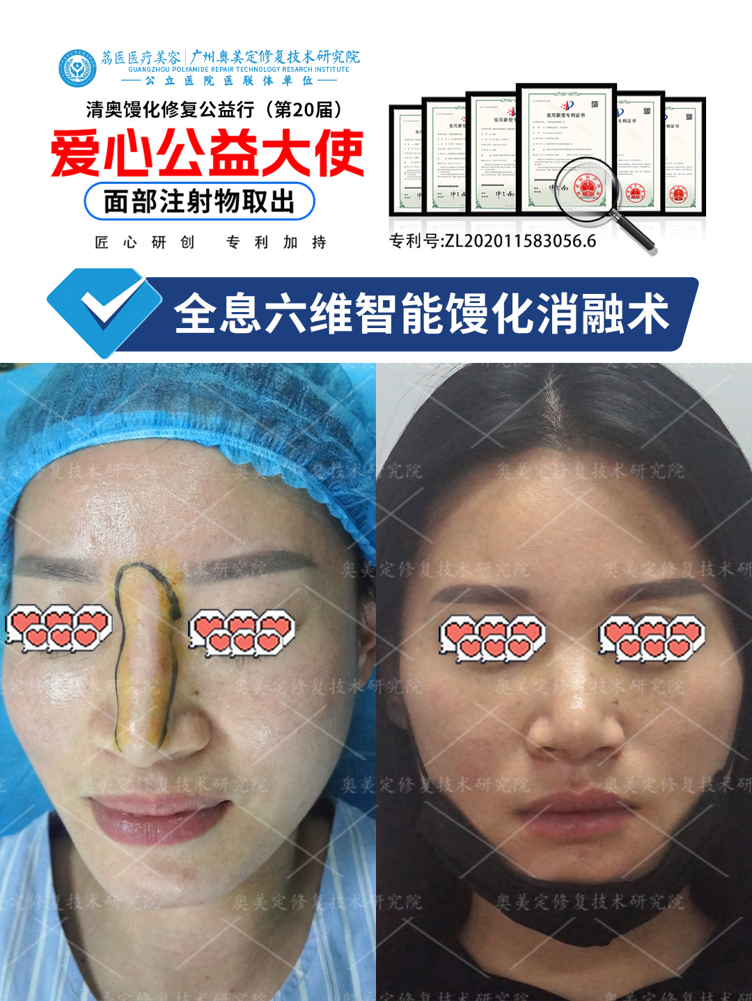 鼻部注射物取出修复，重获自然精致鼻型