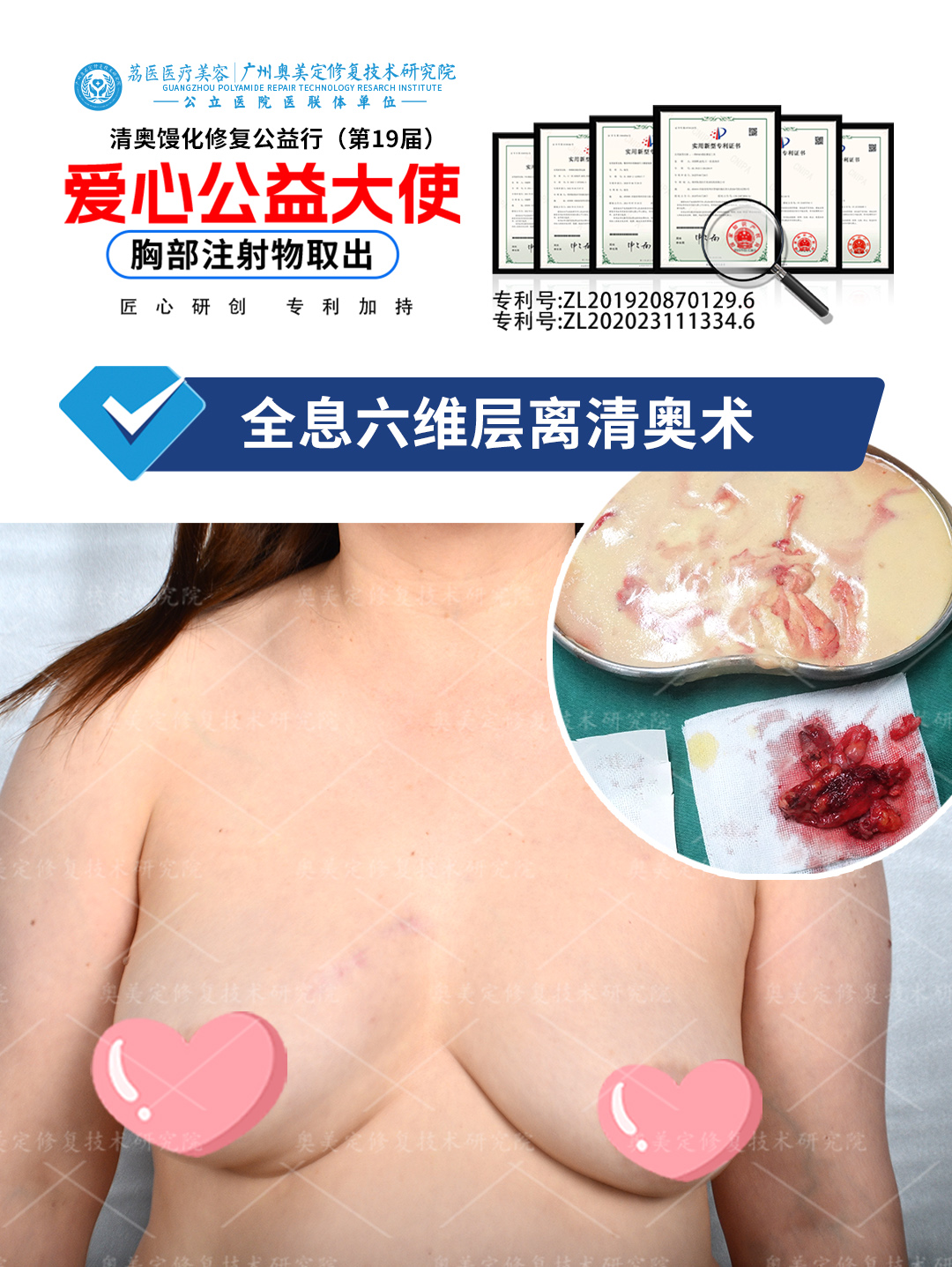 奥美定隆胸后还能取出修复吗？