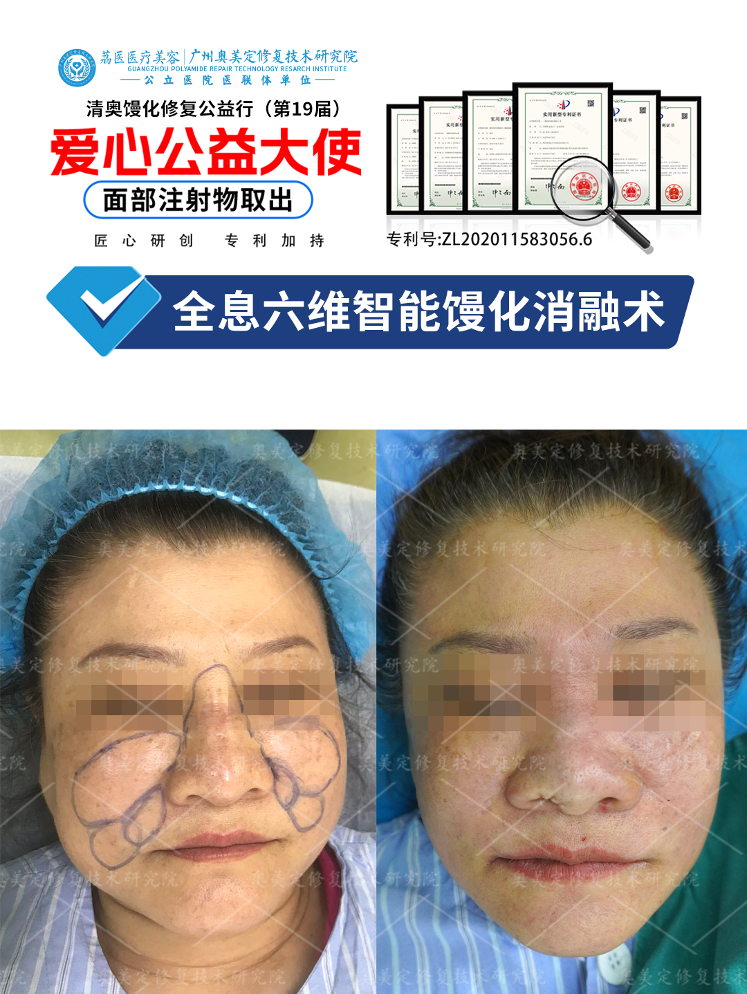 注射生长因子想变美，10年后脸疯长增生