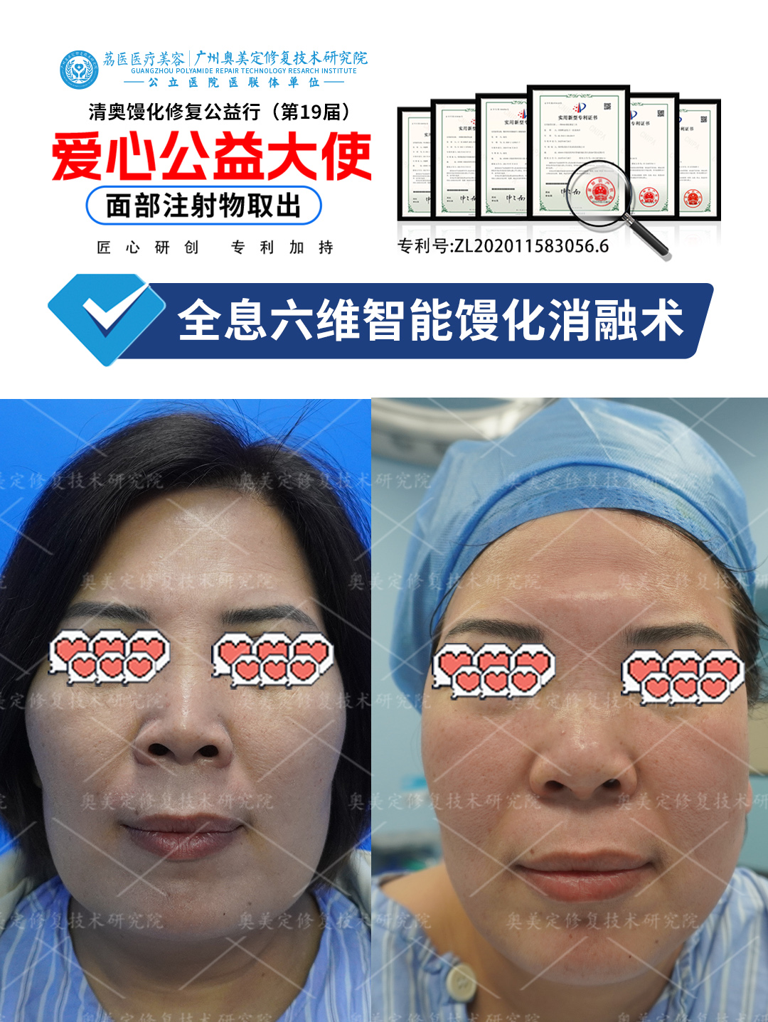 苹果肌填充了奥美定来院成功取出修复