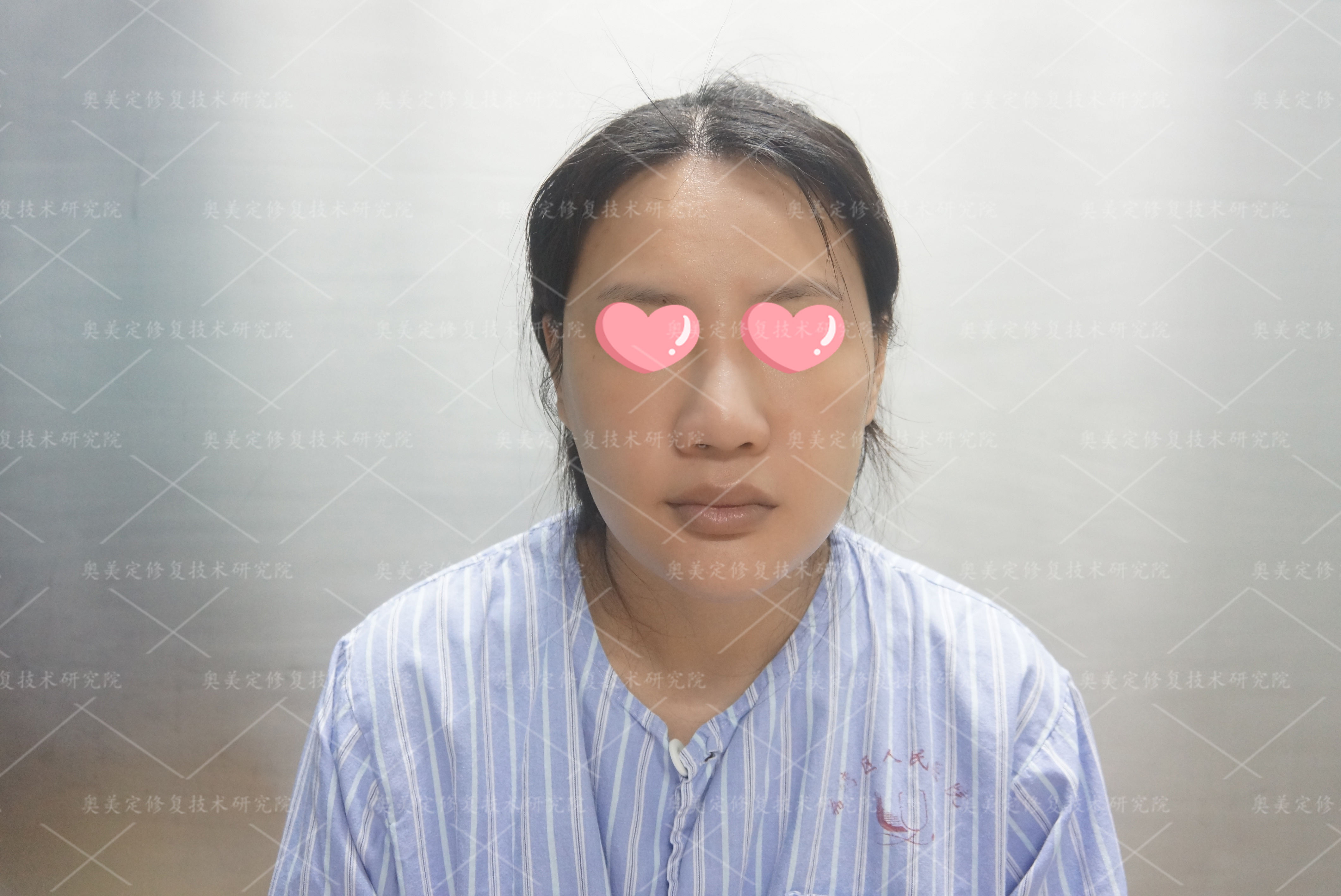 下巴后生长因子怎么取出修复