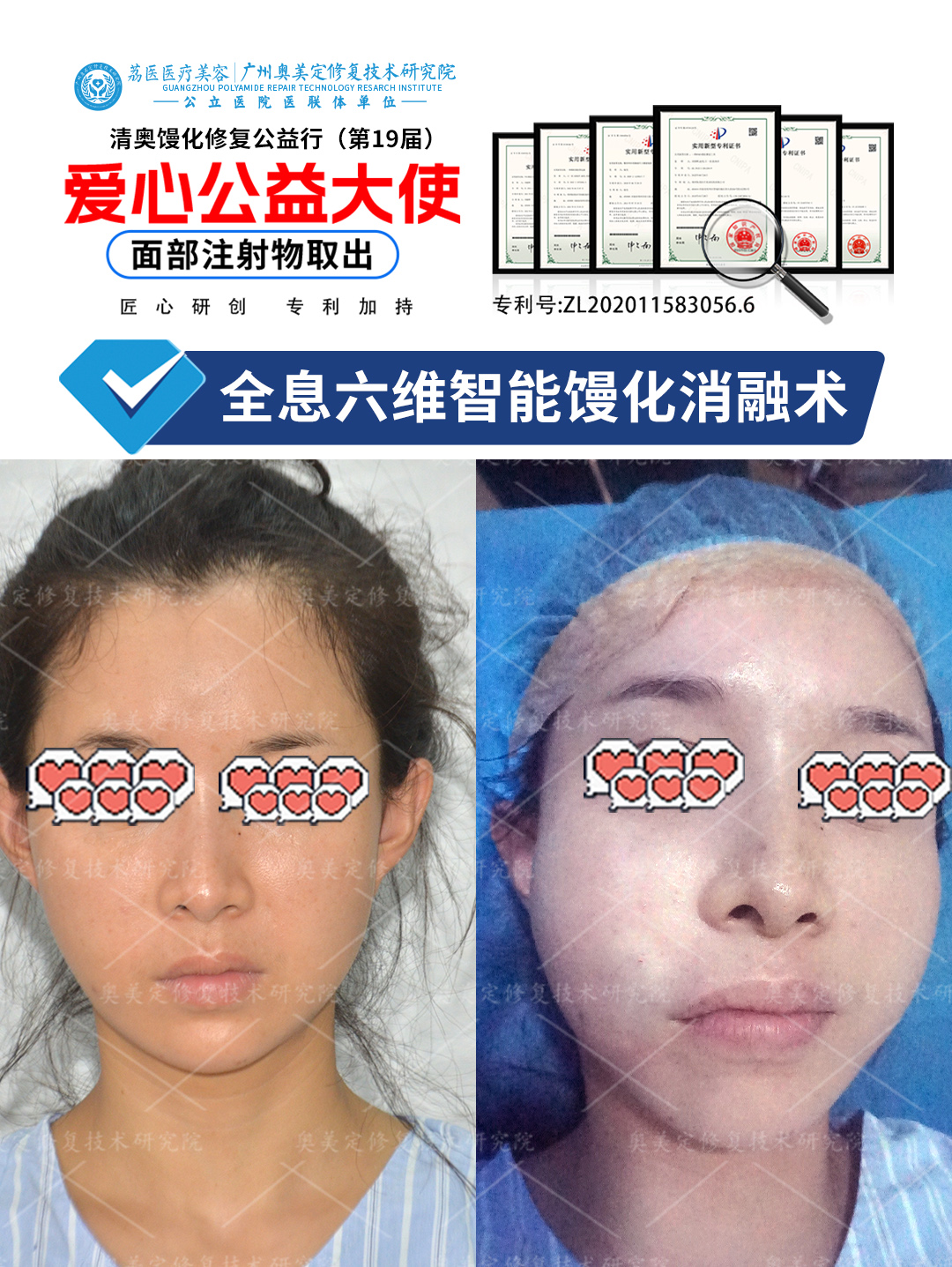 假玻尿酸注射丰苹果肌后如何取出