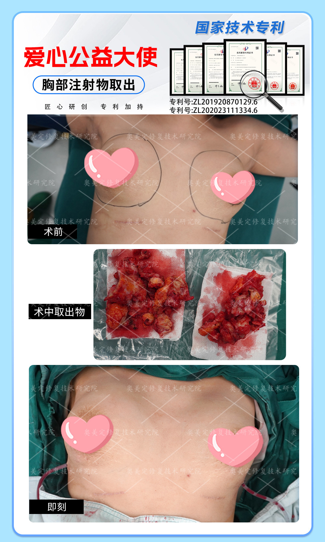 奥美定隆胸后怎么才能取出