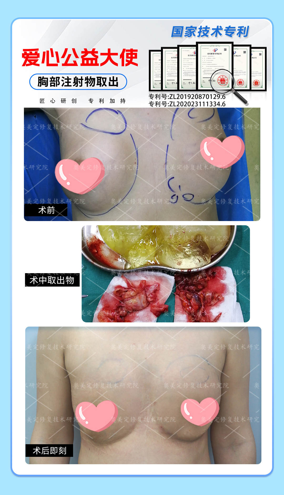 如何才能取出胸部非法材料