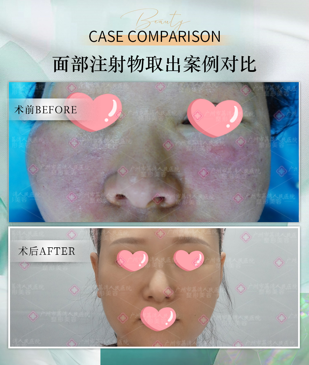 奥美定能取出来吗