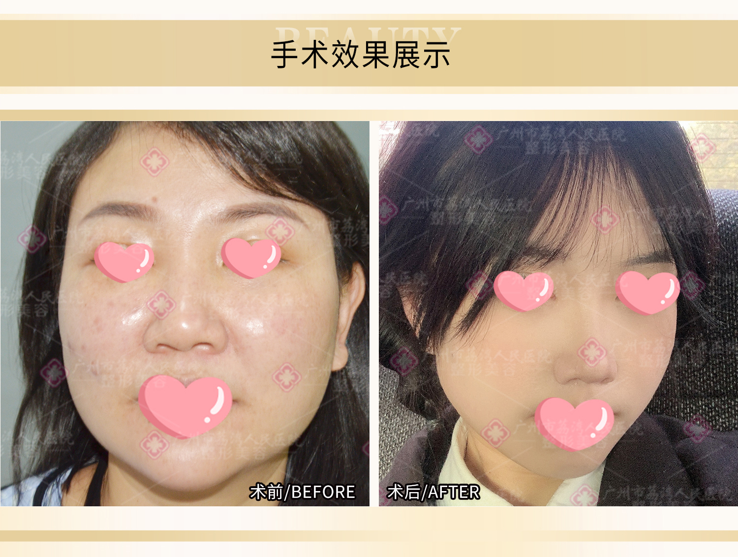 面部打了奥美定要取出吗