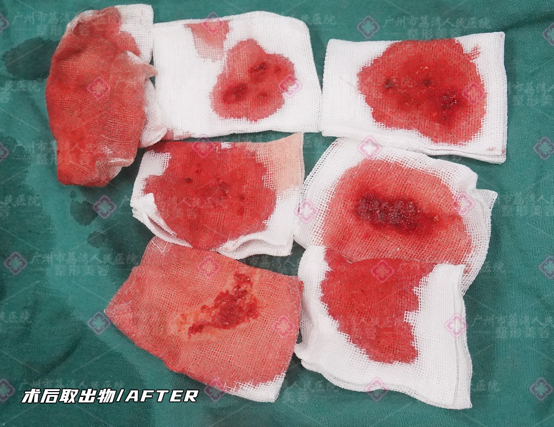 水分子丰体针的成分是非法注射物奥美定