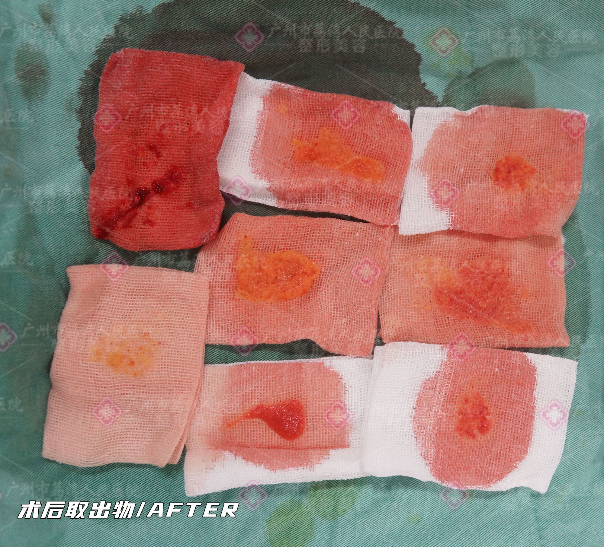 捷克水分子丰体针注入乳房有危险吗