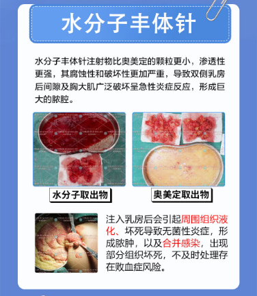 捷克水分子注射隆胸的并发症有哪些
