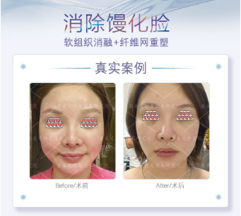 为什么你的脸会变成“发面馒头”？