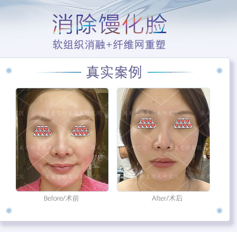 被脂肪填充“泡发”的脸，还能救回来吗？——一位馒化修复患者的自述