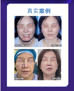 馒化脸会自然消失吗