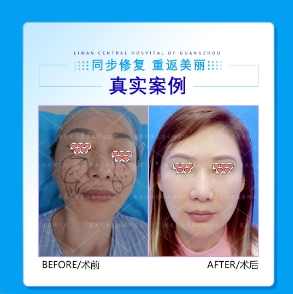 玻尿酸馒化可以溶解吗？