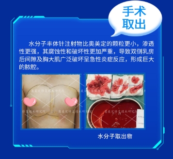 “蜜桃胸”变“定时炸弹”：揭开捷克水分子丰胸的致命陷阱