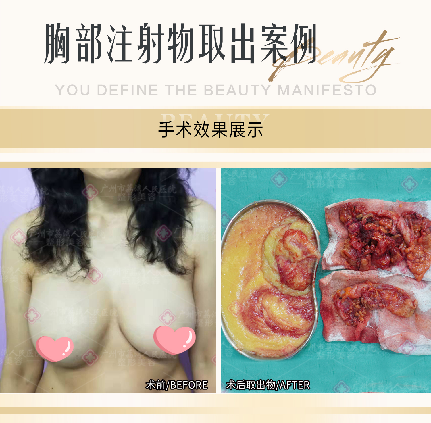 注射了奥美定可以被溶解吗？