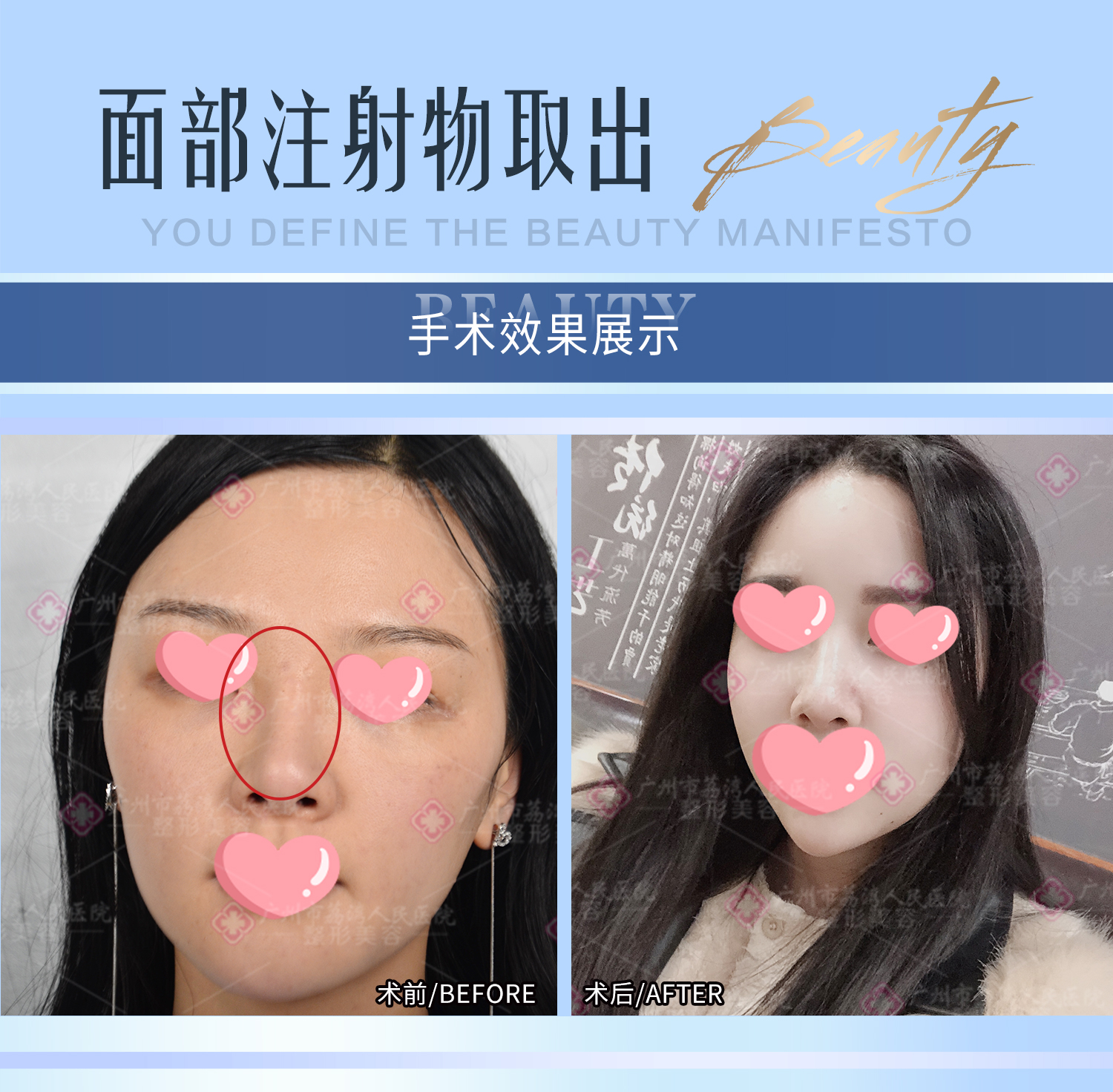 取出面部奥美定会在脸上留疤吗？